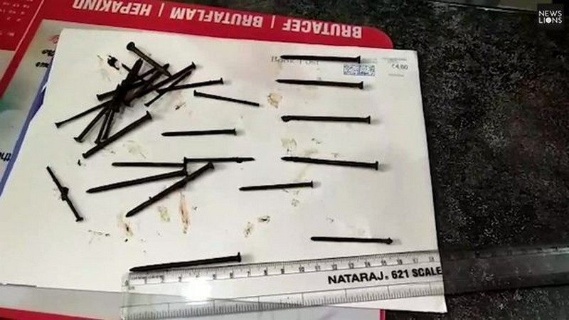 Из 43-летнего индийца достали 116 гвоздей