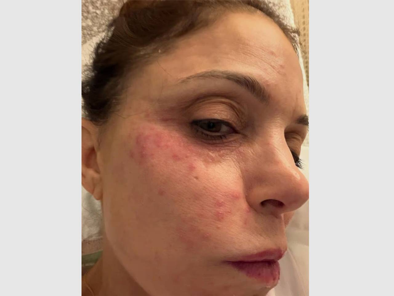 Телеведущая заразилась инфекцией в отпуске из-за отельного полотенца