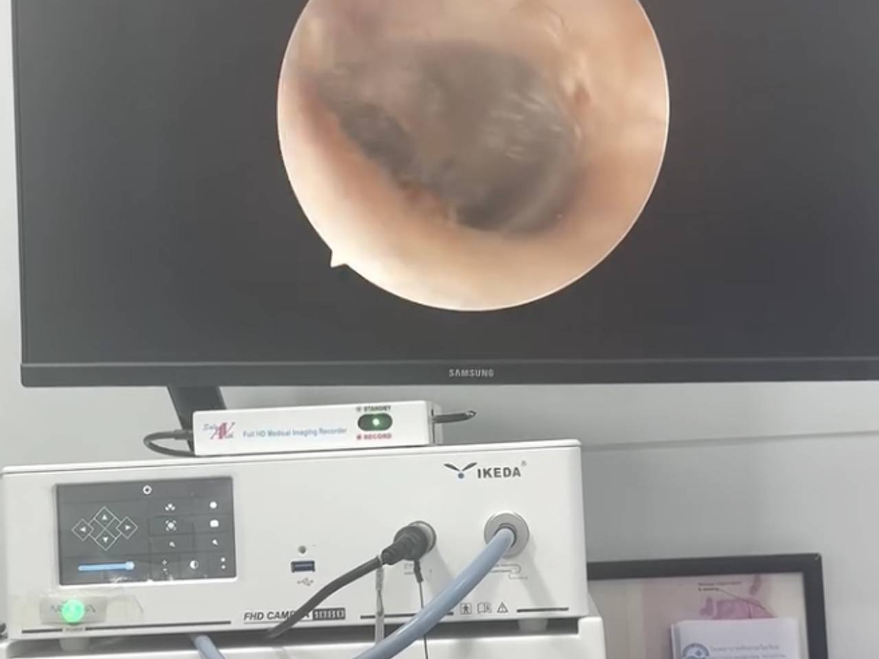 Насекомое поселилось в ухе россиянки во время отдыха в Таиланде