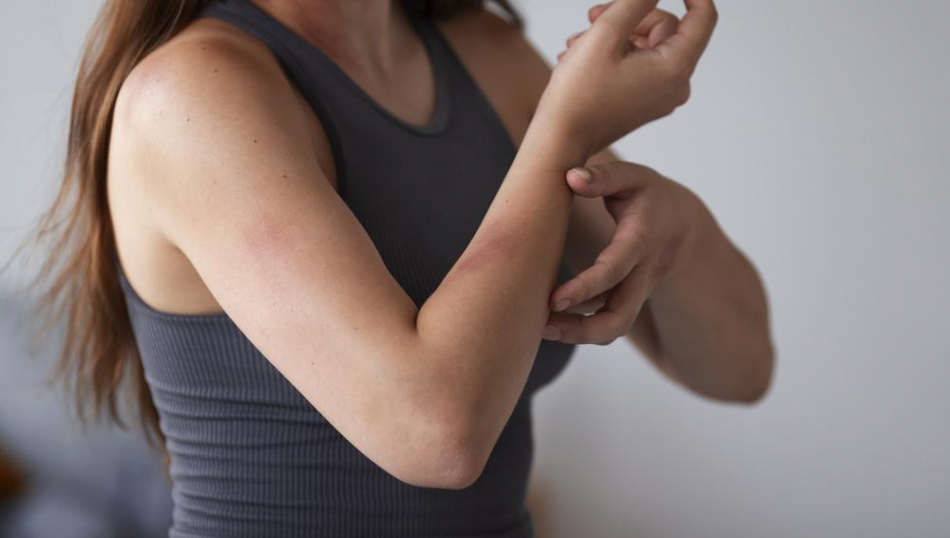 За клопов заплатит туроператор? Туристы пожаловались на насекомых в отеле ОАЭ