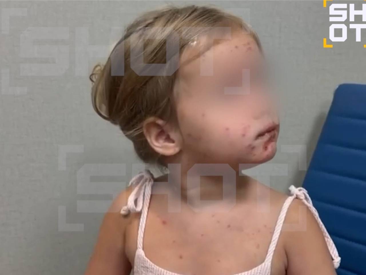 Трехлетняя девочка заразилась кожной инфекцией после укуса комара и купания на Бали